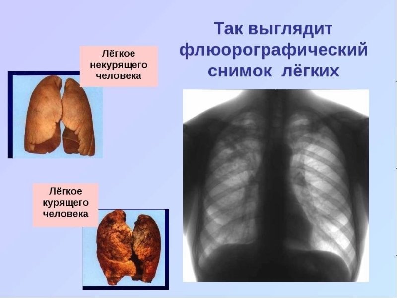 Легкие здорового человека флюорография и легкие курильщика
