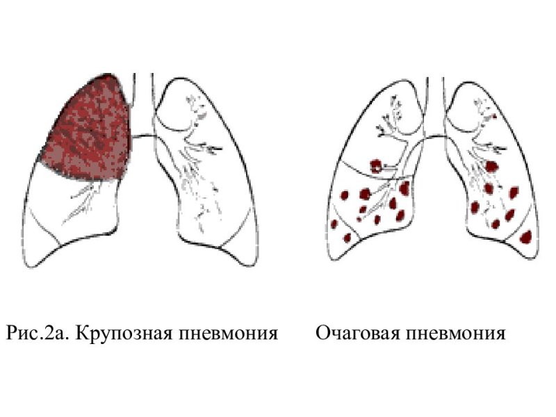 Крупозная и очаговая пневмония
