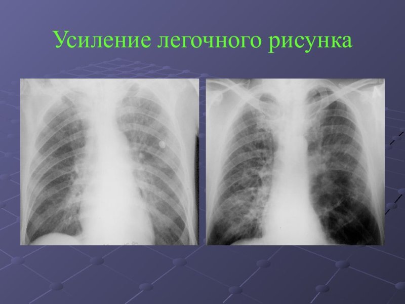 Легочный рисунок усилен
