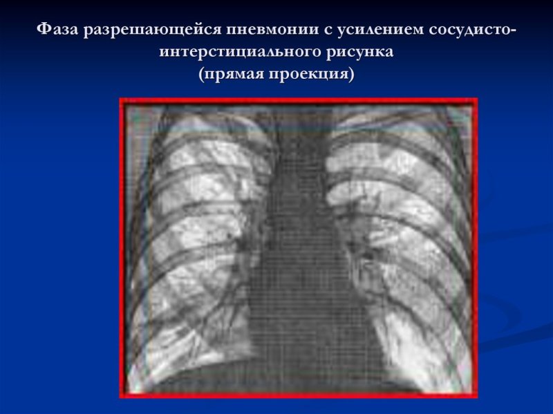 Усиление сосудистого рисунка