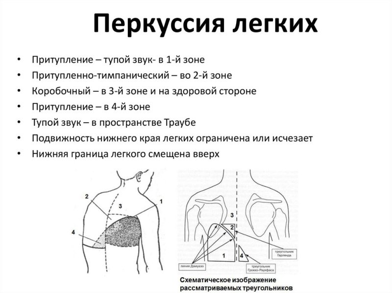 Перкуссия грудной клетки схема