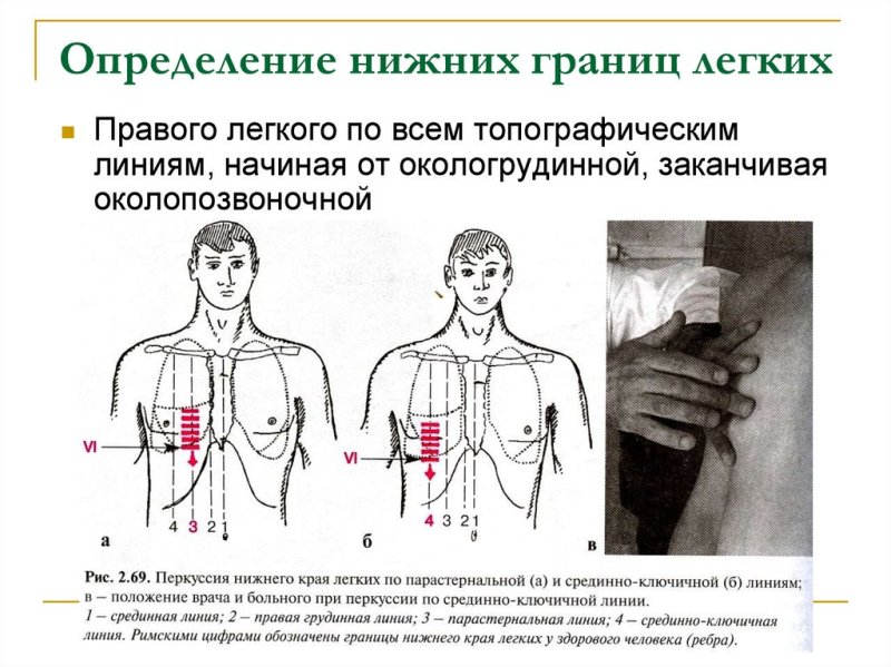 Топографическая перкуссия легких пропедевтика внутренних болезней