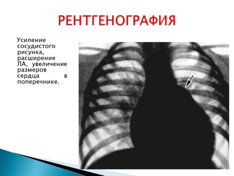 Усиление сосудистого рисунка легких на рентгене