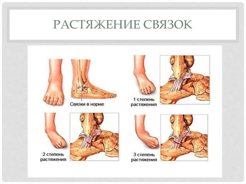 Растяжение голеностопа степени растяжения