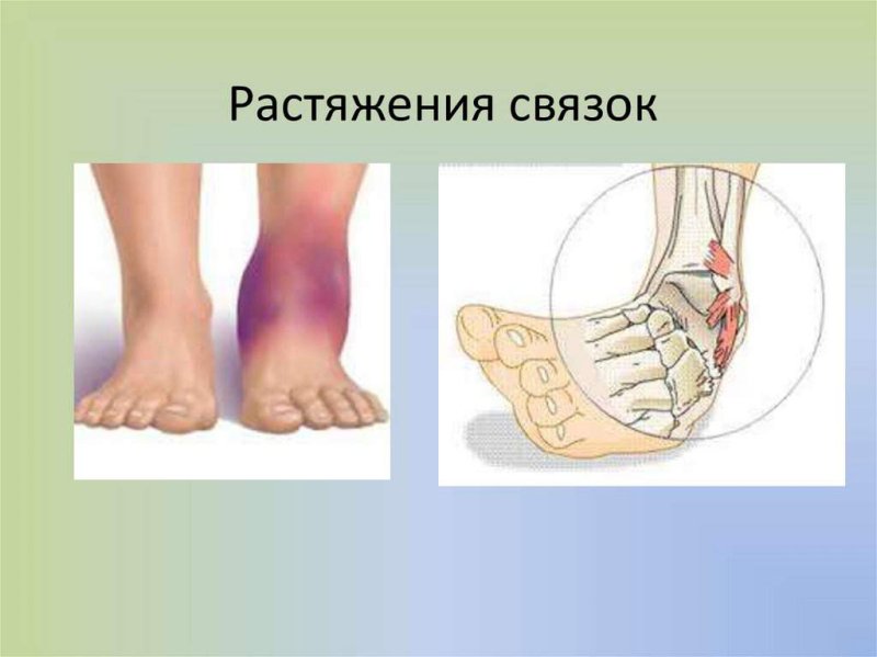 Подвывих голеностопного сустава гематома