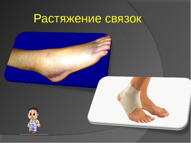 Растяжение и разрыв связок