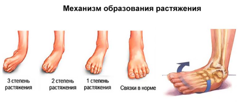 Растяжение связок голеностопа 2 степени